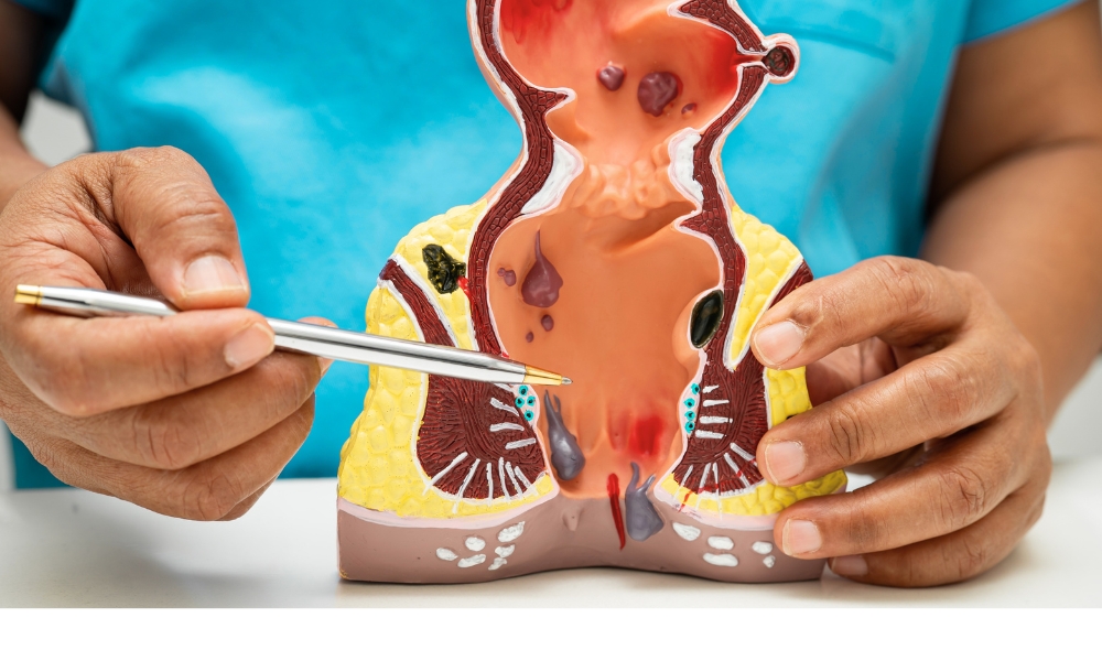 hemoroidi koji krvare